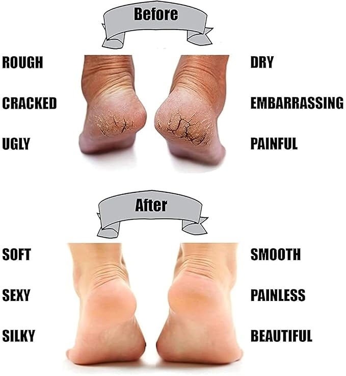 Anti Foot Crack